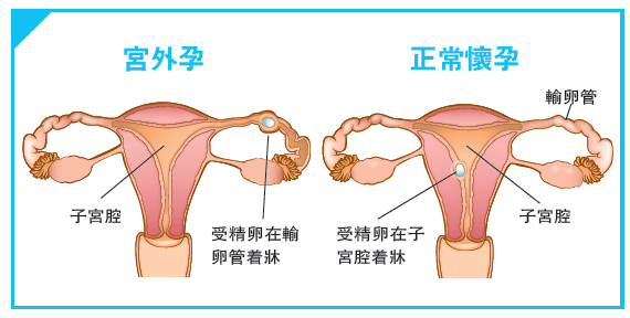 从怀孕到宫外孕,一场难忘的惊险之旅_小丽_腹腔_结扎手术