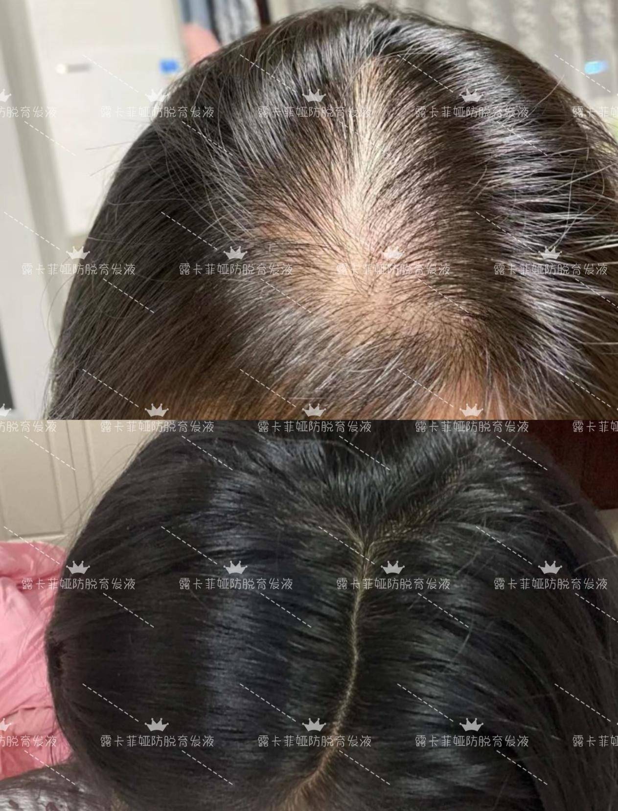 测评防脱发洗发水哪个牌子好用脱发自救指南