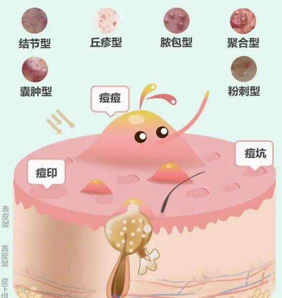 皮脂腺囊肿 病因图片