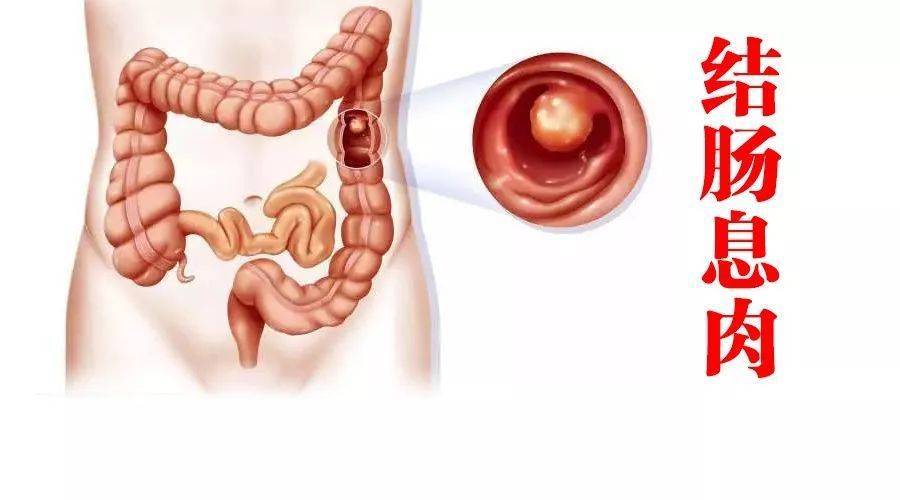 原创结肠息肉需要切除吗有何危害高风险群体有哪些如何治疗