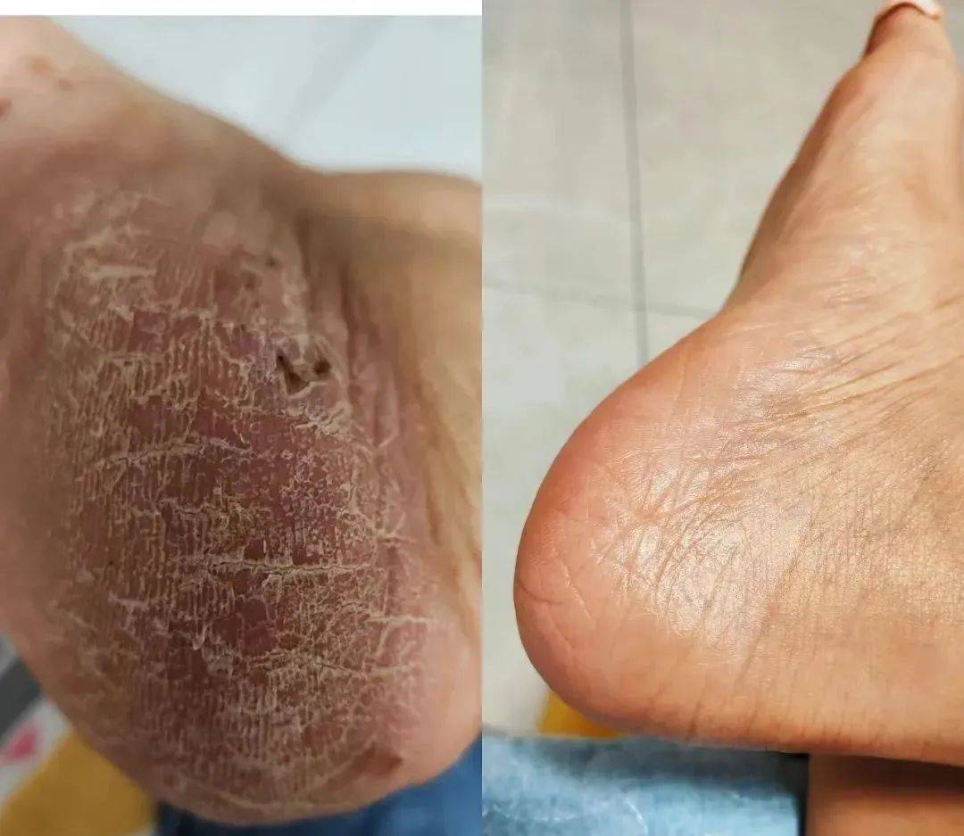 今健医皲裂膏,30天让你脚跟焕然一新!
