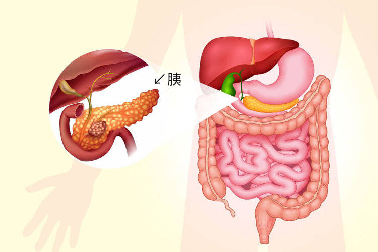 胰腺癌诊断证明图片图片