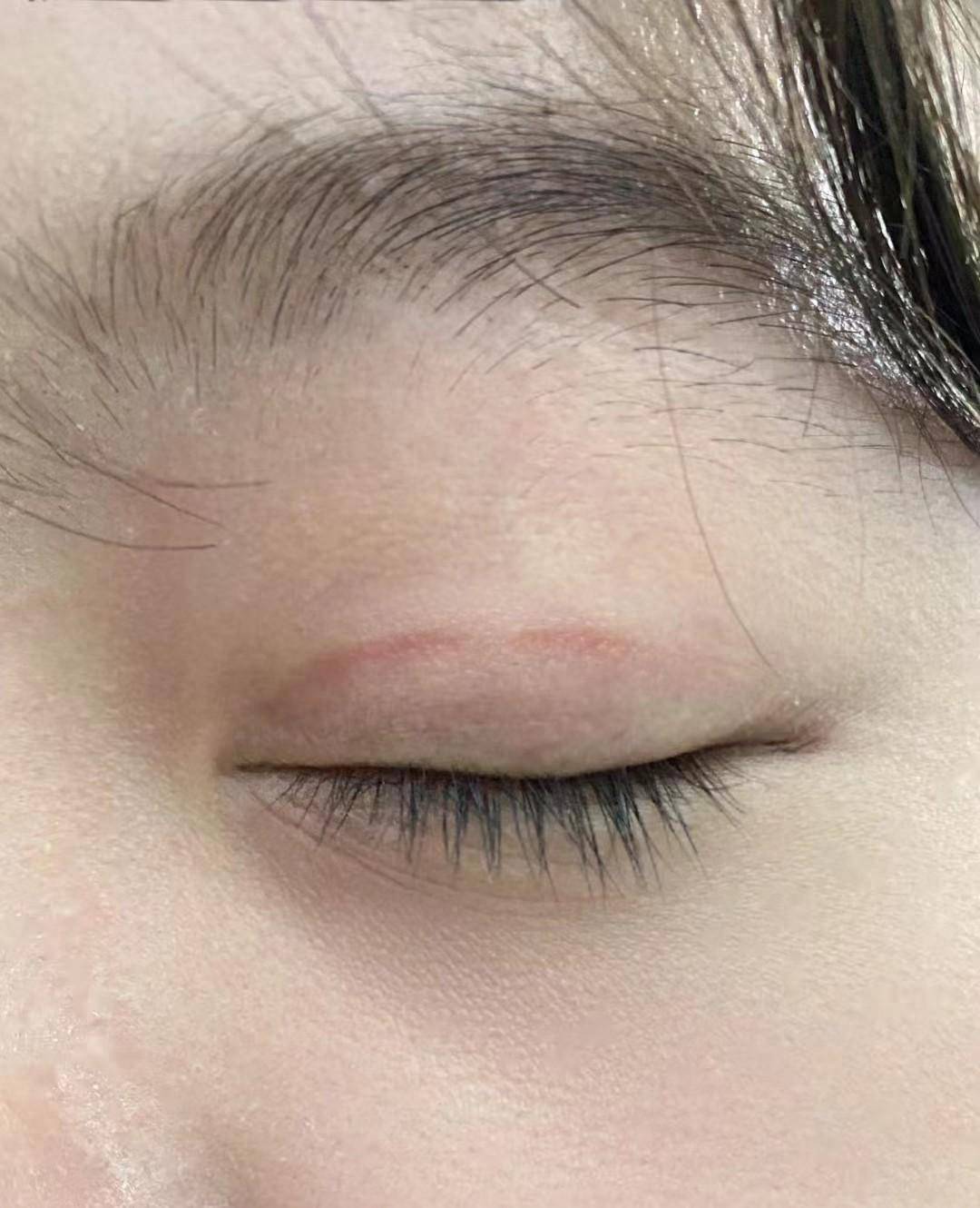 双眼皮出现疤痕增生,到底该怎么正确修复?