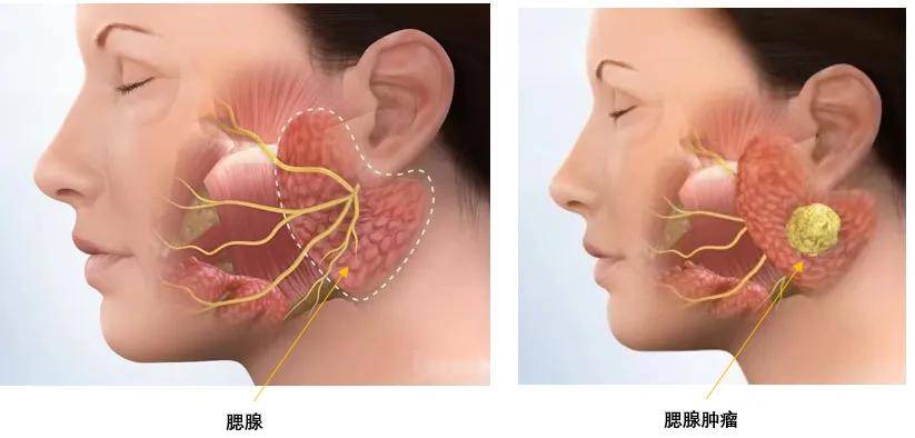 腮腺混合瘤美容切口图图片