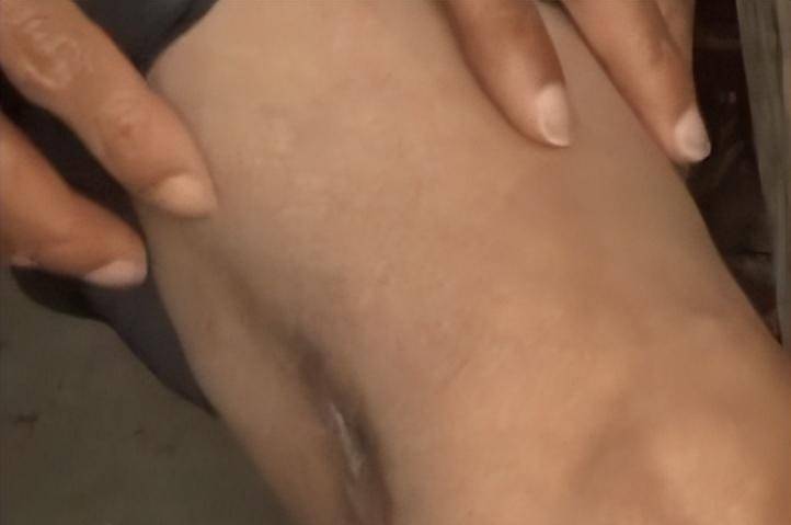 一次干活过程中,他不小心从楼上摔下,一根钢筋直直地扎在了脚上贯穿