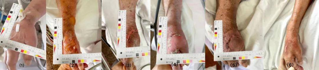 示范案例1例药物渗出引起患者皮肤损伤的护理报告