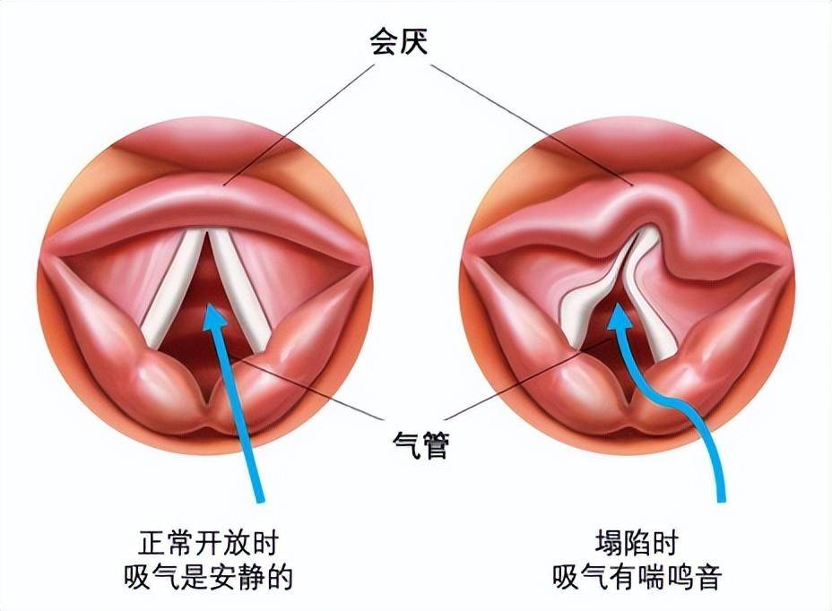 宝宝喉咙呼噜呼噜响一定是有痰吗？可能是喉软骨软化,严重可能窒息