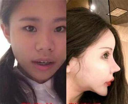 原创还记得13岁就整容的网红女孩吗3年整60次同学再见时已认不出