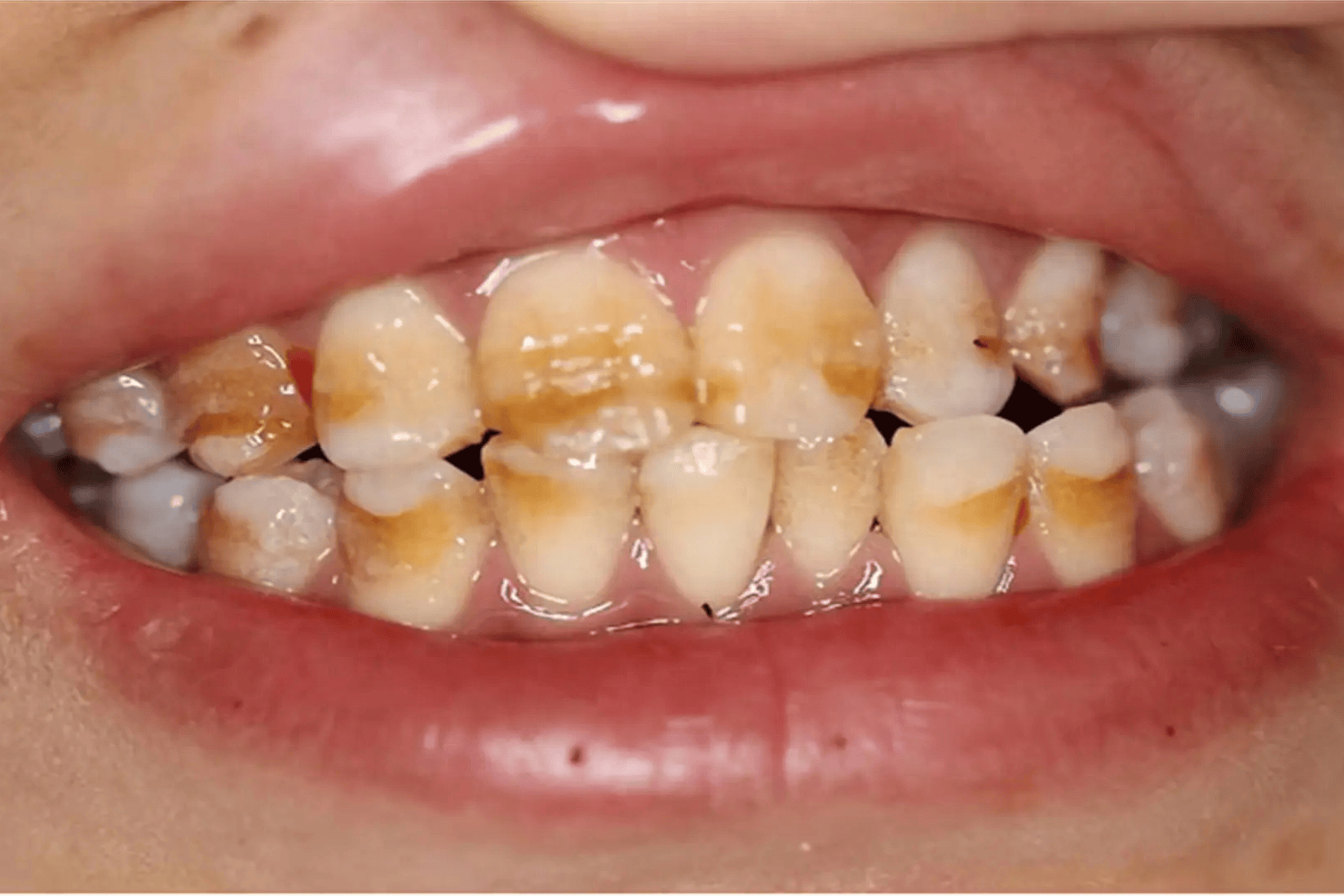 3年没洗牙,牙齿依然又白又亮!大黄牙赶紧来学习方法!