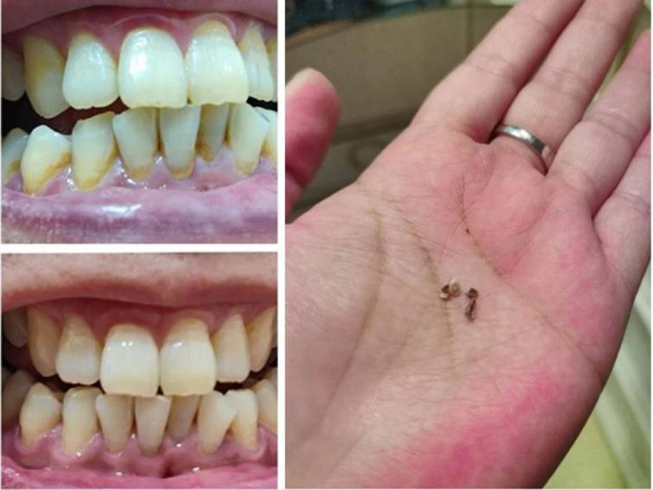 这才是真正的去牙石良方只需每日简单刷一刷牙结石轻松去除