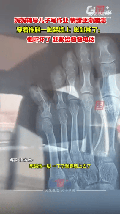 原创女子辅导儿子作业情绪崩溃踹断脚趾