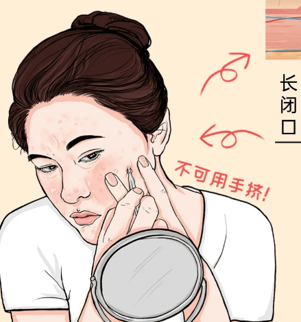 为什么长闭口的总是你,闭口如何预防和改善_粉刺_祛痘_皮肤