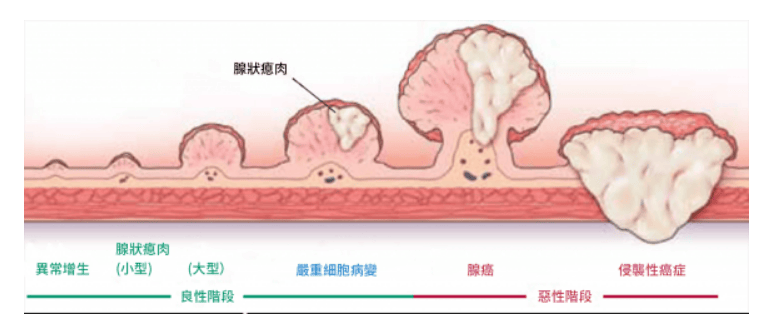 这种息肉十有八九会癌变