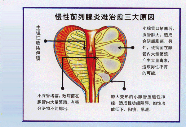 预防前列腺癌的五大营养(上)