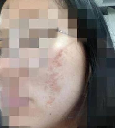 被爆多名大学生惨遭毁容!一些护肤细节赶紧收藏_皮肤_化妆_面膜