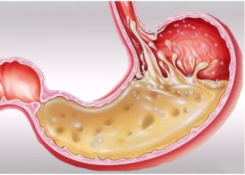 幽门螺杆菌克星已公布不是紫甘蓝每天吃一点胃干净舒服