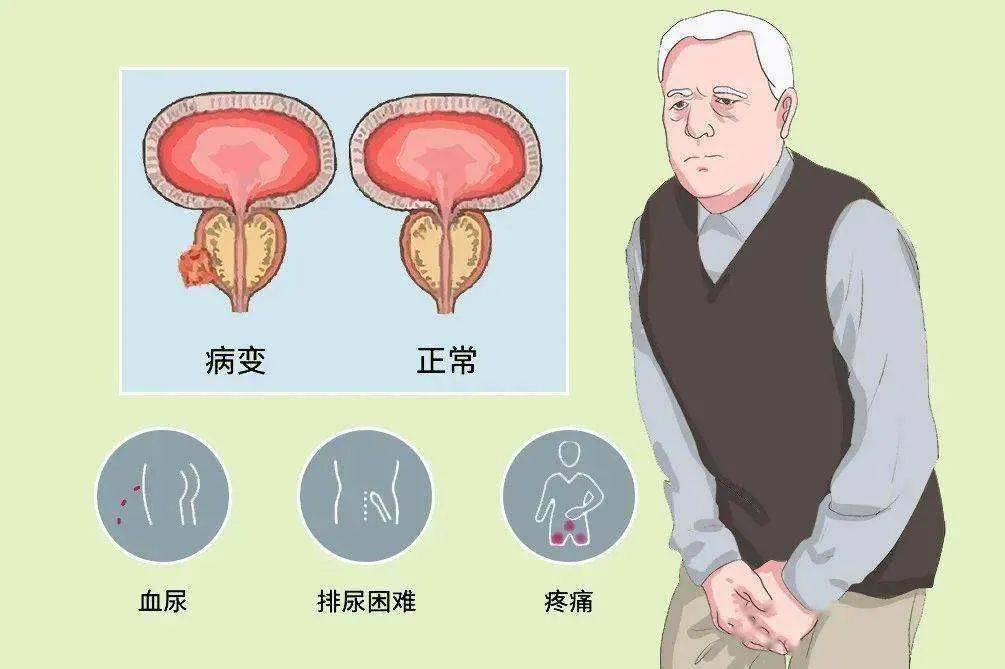 光邦光子治疗仪:前列腺大≠前列腺增生?到底是怎么回事?