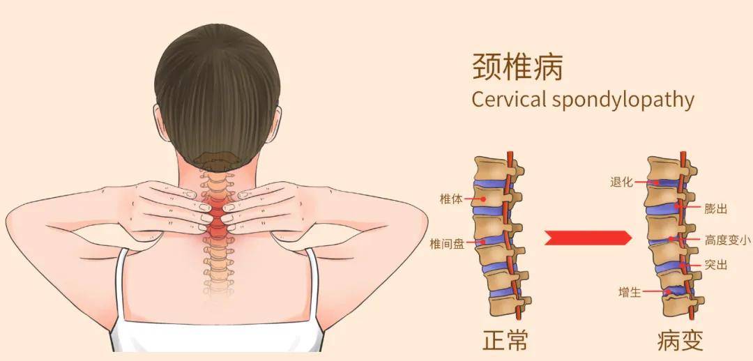 苏州明基脊柱外科颈前路椎体次全切融合术解决脊髓型颈椎病大难题