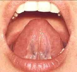 中医教你看舌头 —— 舌头下的青筋