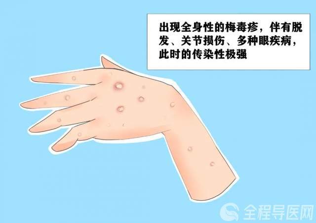 北京地坛医院徐州医院感染性疾病专家韩宇:梅毒不是霉毒