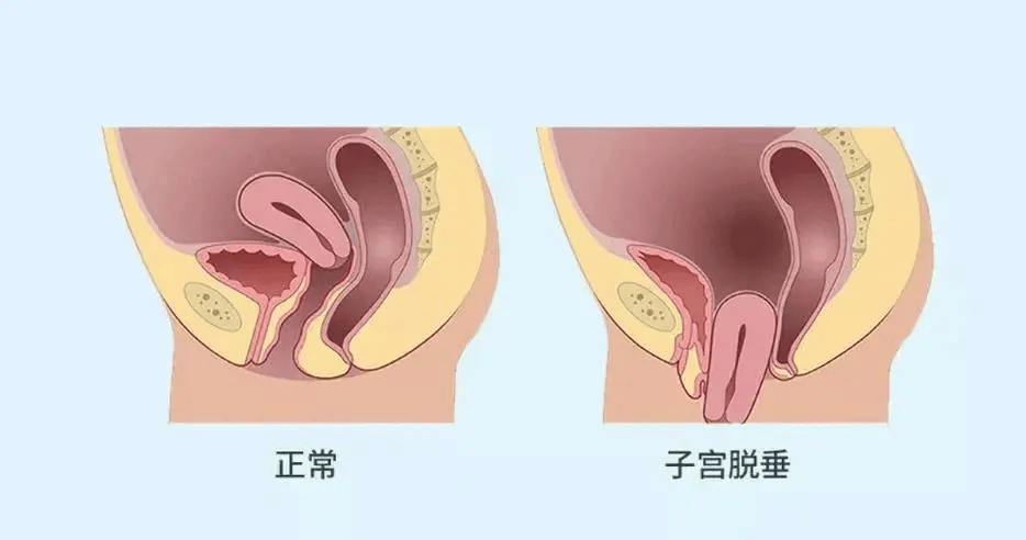 子宫下垂有什么症状图片