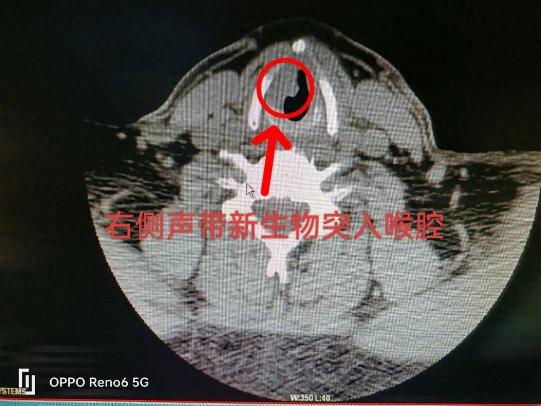 这项技术让70岁喉癌老人保喉又保声_李大爷_治疗_手术
