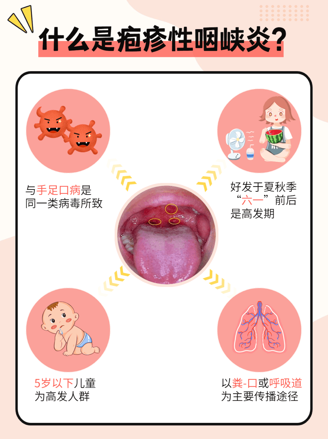 气温上升,疱疹性咽峡炎开始"抬头",竹海堂防治小攻略请收好!