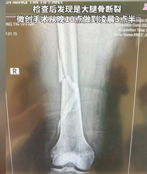 向太不慎摔倒，大腿骨断裂——生活中的意外与坚强