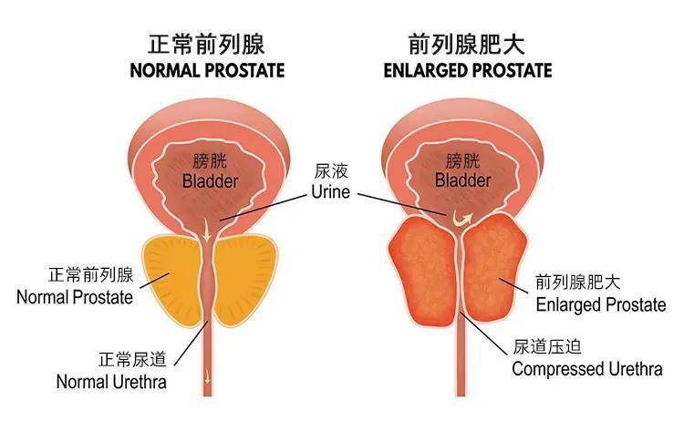 怎样找到自己的前列腺图片