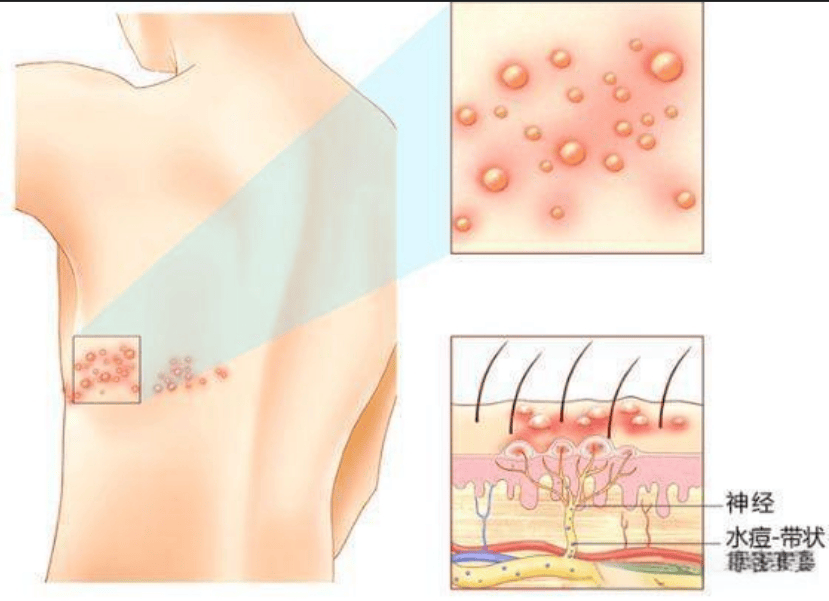 带状疱疹是什么 带状疱疹预防小知识 带状疱疹又叫蛇缠腰?
