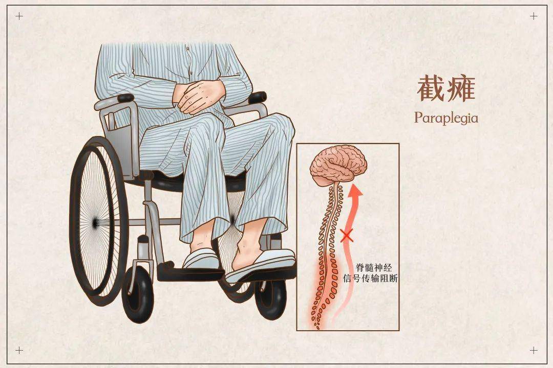 脊髓损伤导致下肢截瘫 出现腿部疼痛是怎么回事