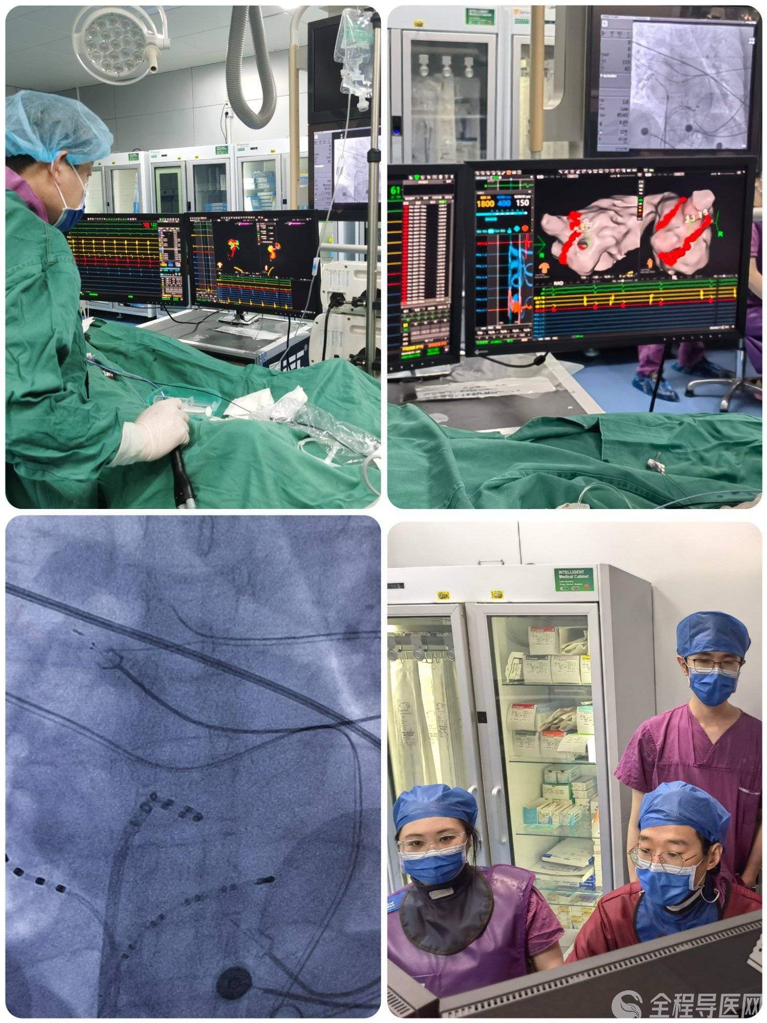 既往曾行下腔静脉滤器植入,术前左房cta显示肺静脉存在变异(左侧肺