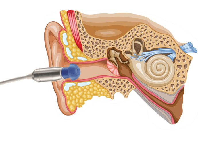 耳声发射在听力保健中的重要作用