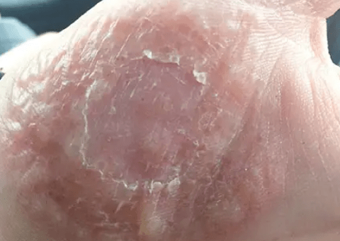 手上皮肤瘙痒难耐!手癣和手部湿疹怎么区分?_发病_部位_水疱