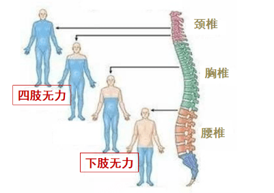 脊髓损伤分布图图片