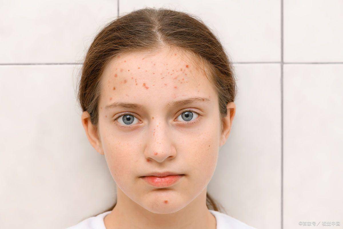 女生脸上不同部位长痘的潜在原因