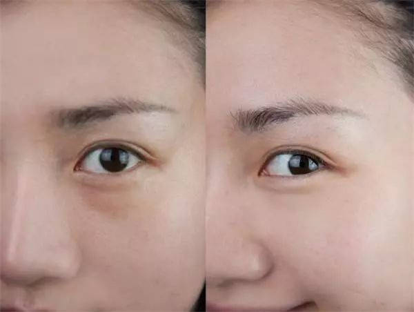 聊聊祛眼袋手术多久可以恢复自然,做完眼袋手术恢复期得多长时间