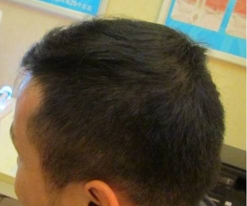 那些植发的人,最后都怎么样了?以后真的不会再掉发了吗?