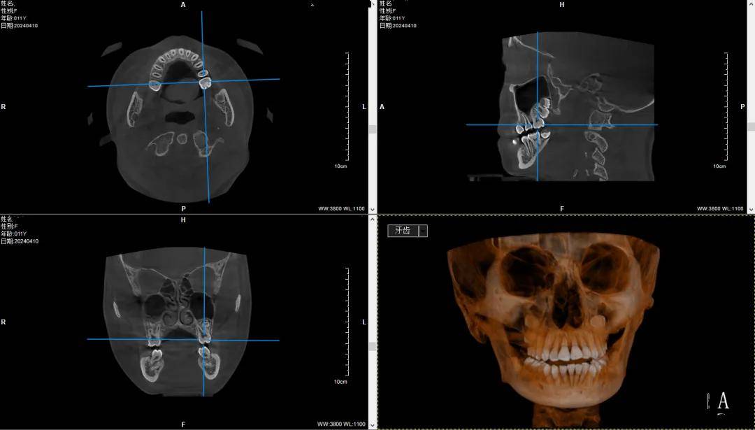 皓月2.0五合一cbct携手袁林天儿童口腔,全心全意守护儿牙健康