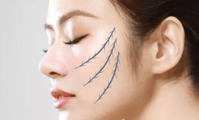 早读~40岁适合做线雕还是拉皮,线雕和拉皮哪个效果好