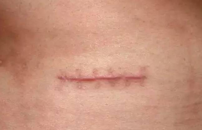 该如何修复?_成都美容整形医院疤痕胎记科