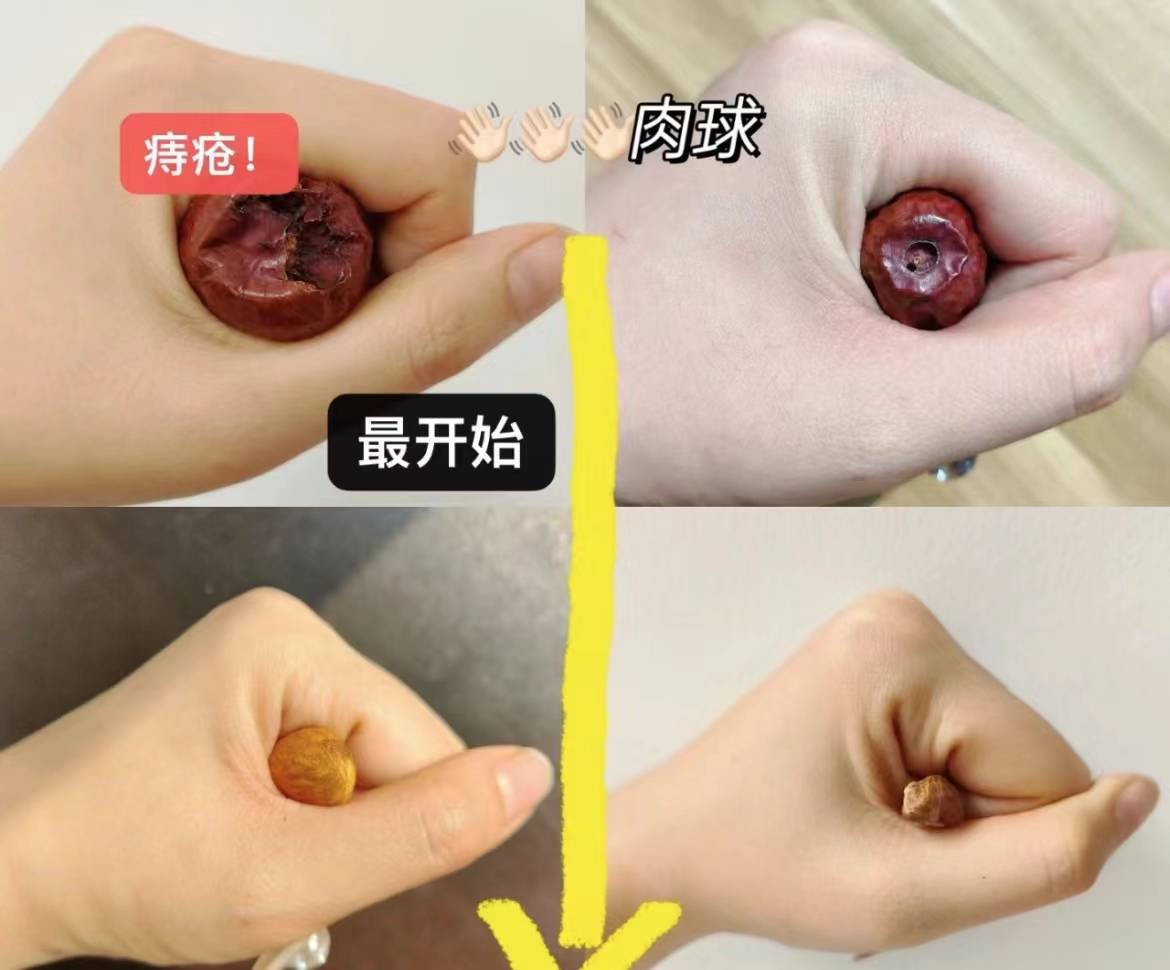 如何在21天内让痔疮肉球消失,快来了解详情!