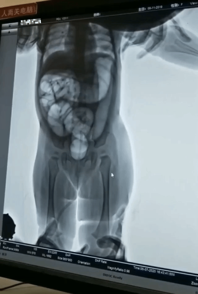 检查时间,而且图像分辨率高,透视图像清晰,更加利于动态观察整复情况