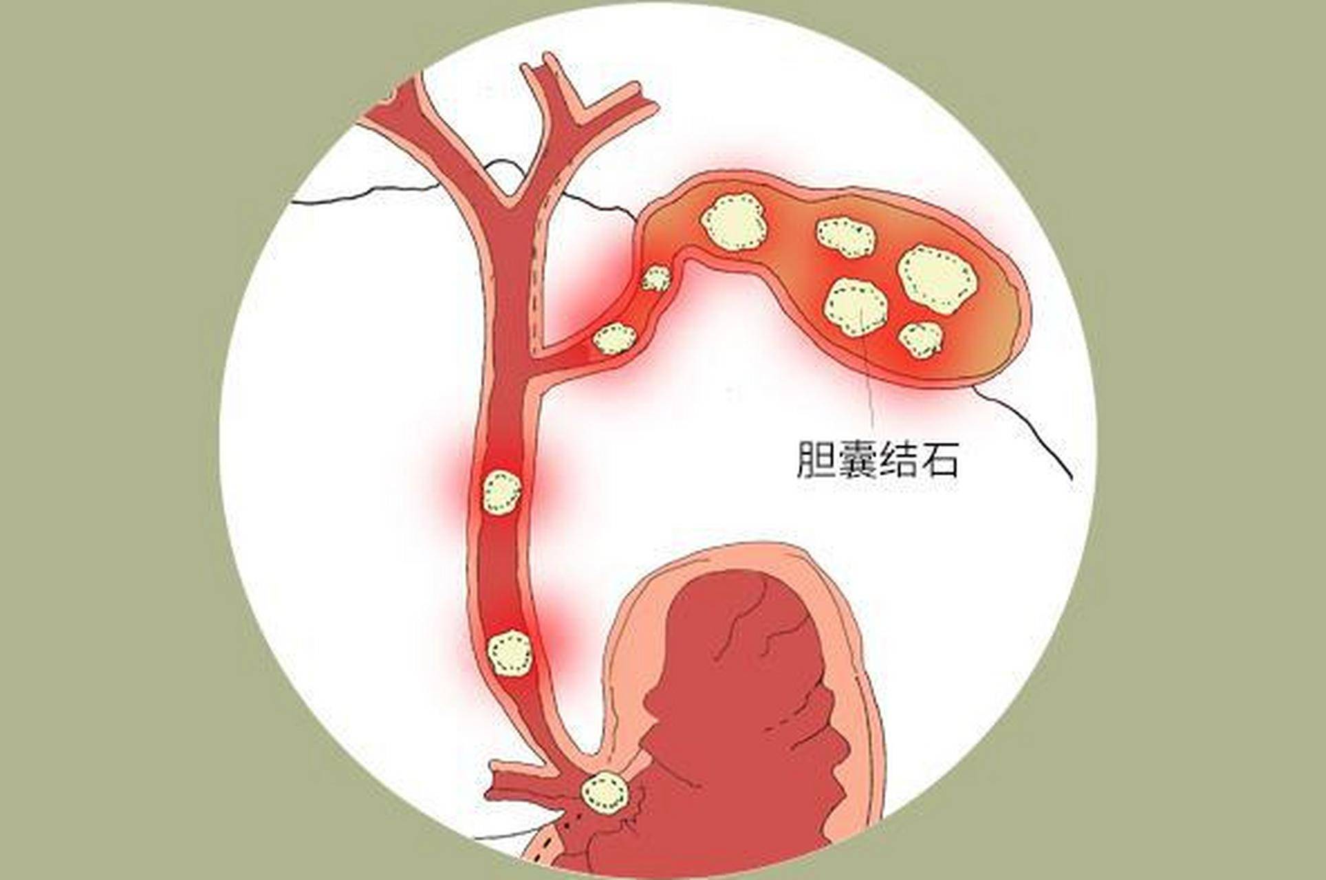 胆囊结石临床表现图片