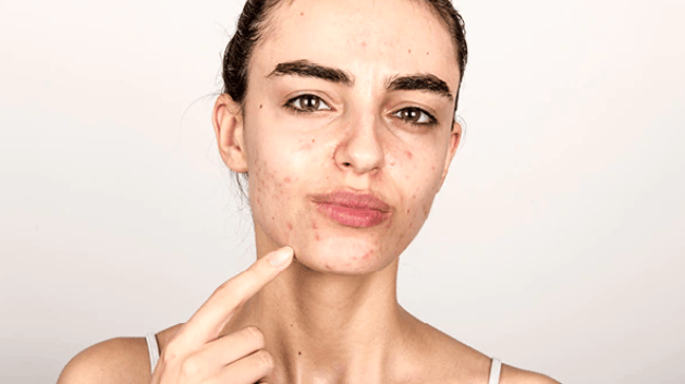 肌肤过敏的原因是因为肤质干燥,导致防护机能降低,只要去除多余的皮脂