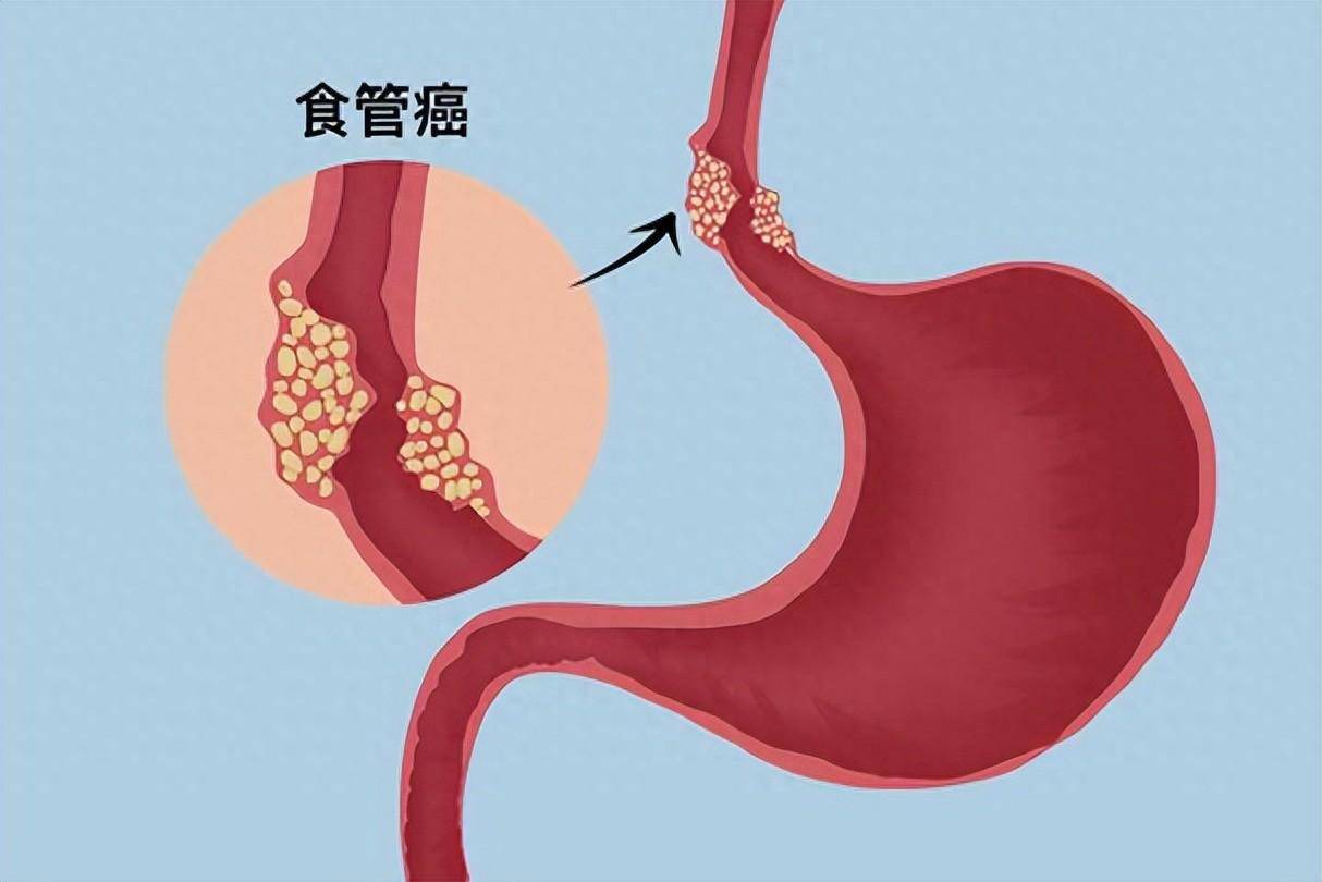 中国巴雷特食管癌变率图片