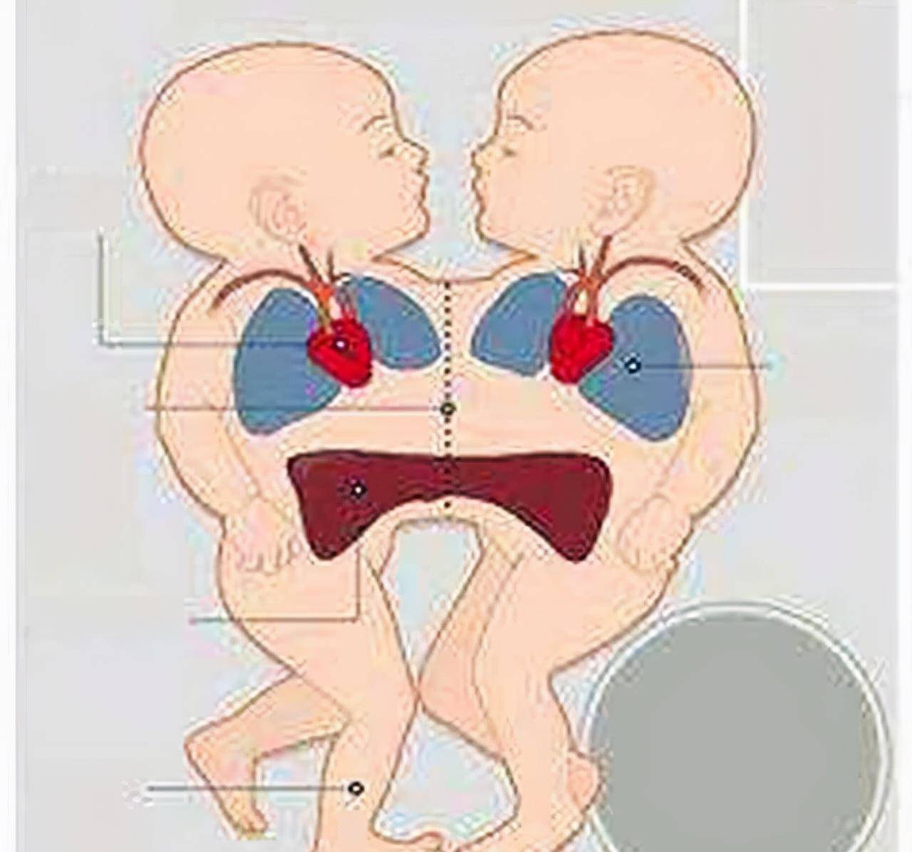 连体兄弟38年前成功分割,弟弟迎娶交往11年的女友,哥哥英年早逝