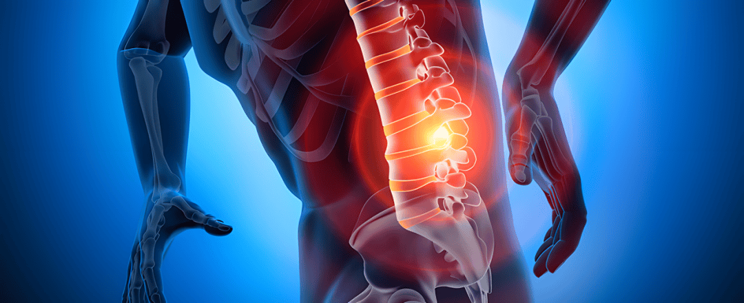 腰椎间盘突出症患者如果出现大腿后侧疼痛,首先就要考虑是不是坐骨