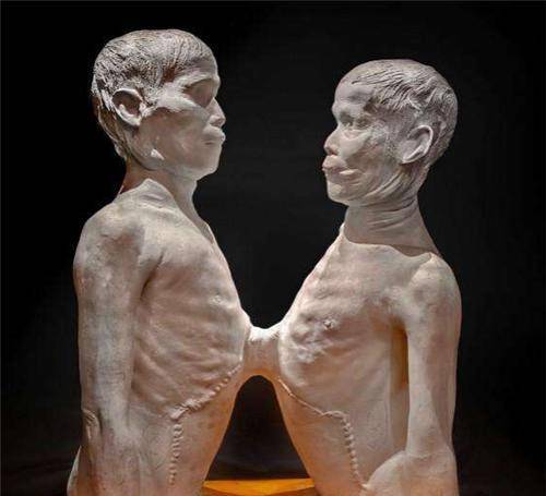 华裔连体兄弟,因身体特殊被展览,走红后还娶了一对双胞胎姐妹