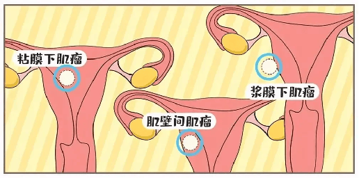 子宫前壁肌瘤的位置图图片